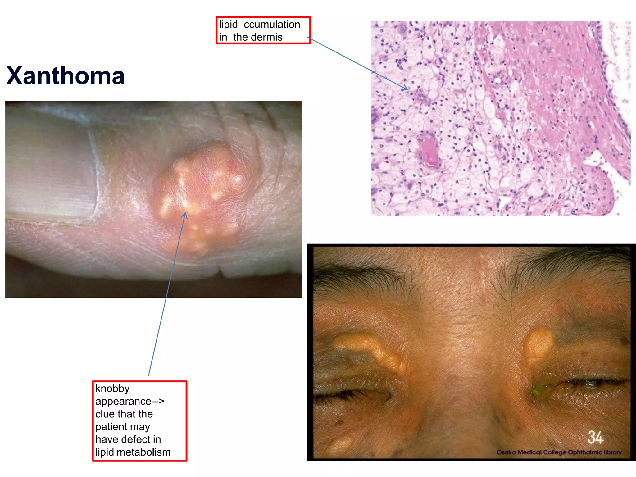 Xanthoma
lipid ccumulation
in the dermis
knobby
appearance-->
clue that the
patient may
have defect in
lipid metabolism
 