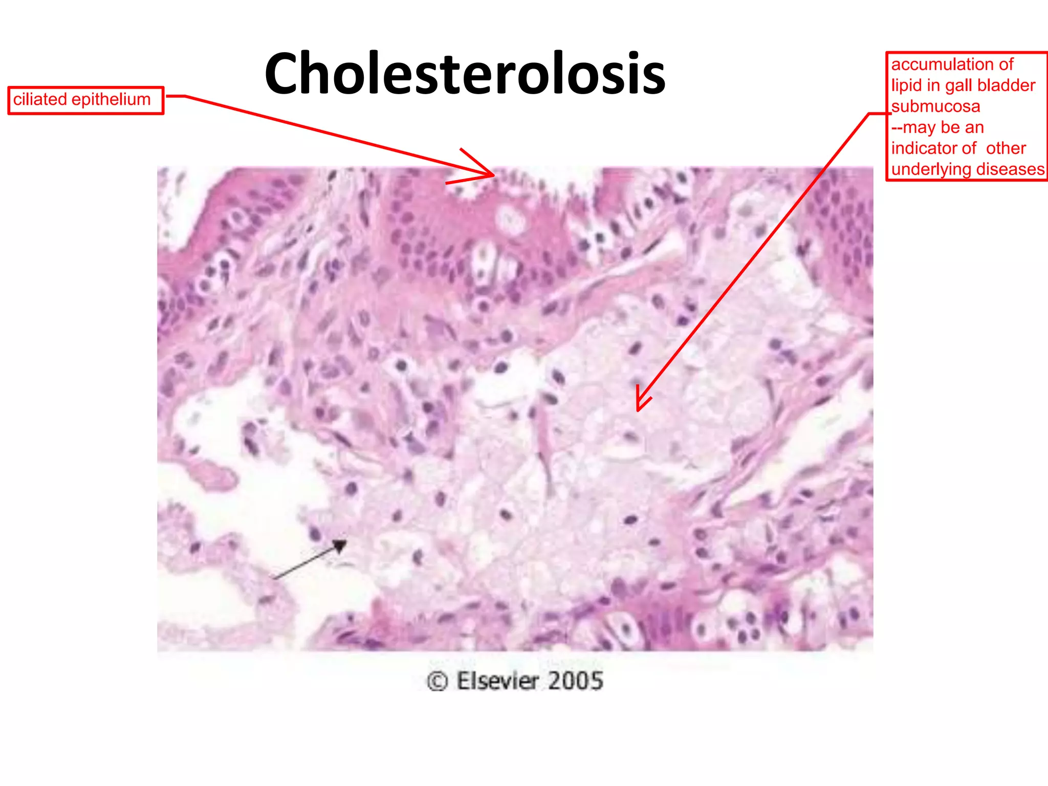 Cholesterolosisciliated epithelium
accumulation of
lipid in gall bladder
submucosa
--may be an
indicator of other
underlying diseases
 