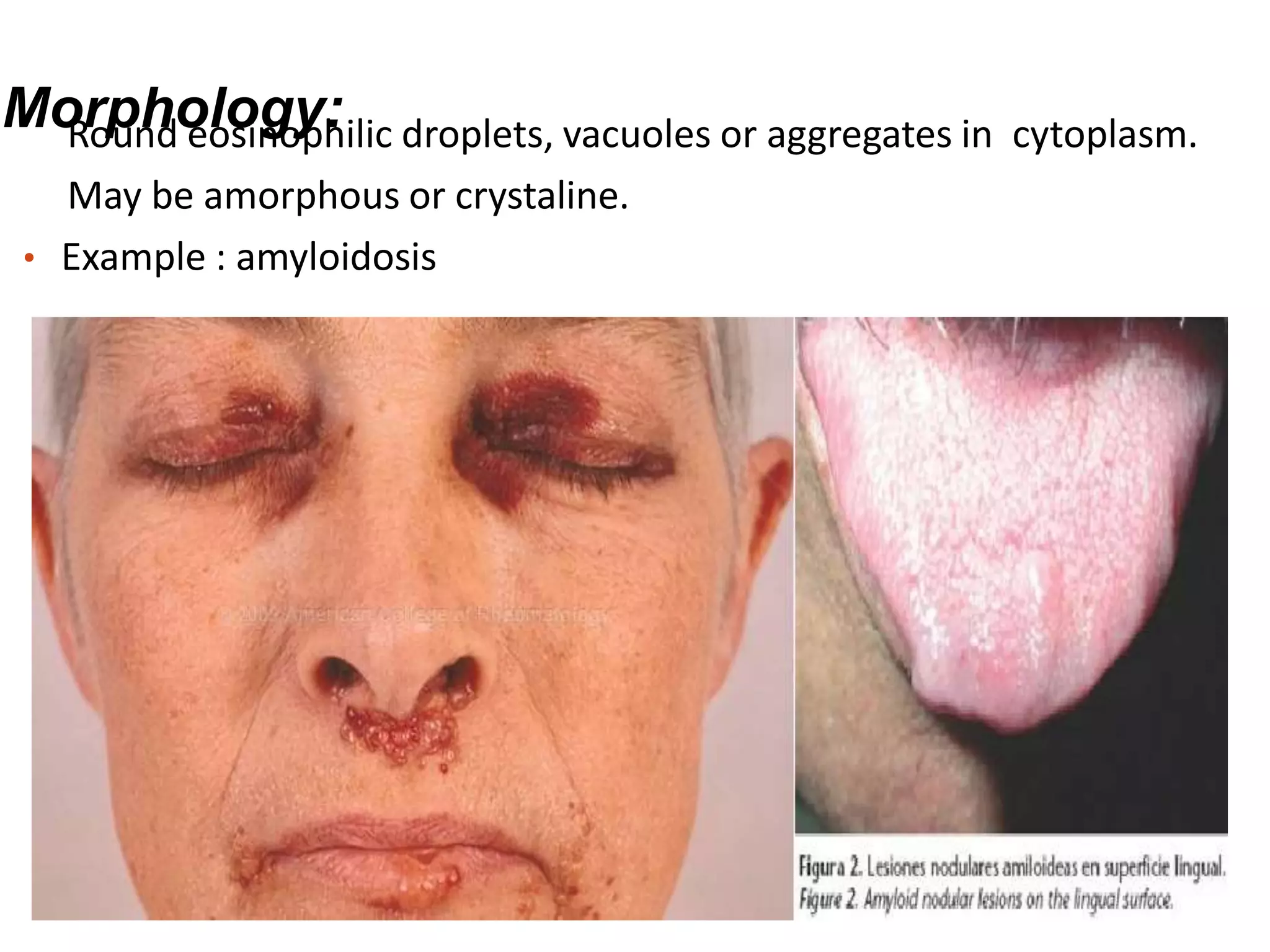 Morphology:Round eosinophilic droplets, vacuoles or aggregates in cytoplasm.
May be amorphous or crystaline.
• Example : amyloidosis
 