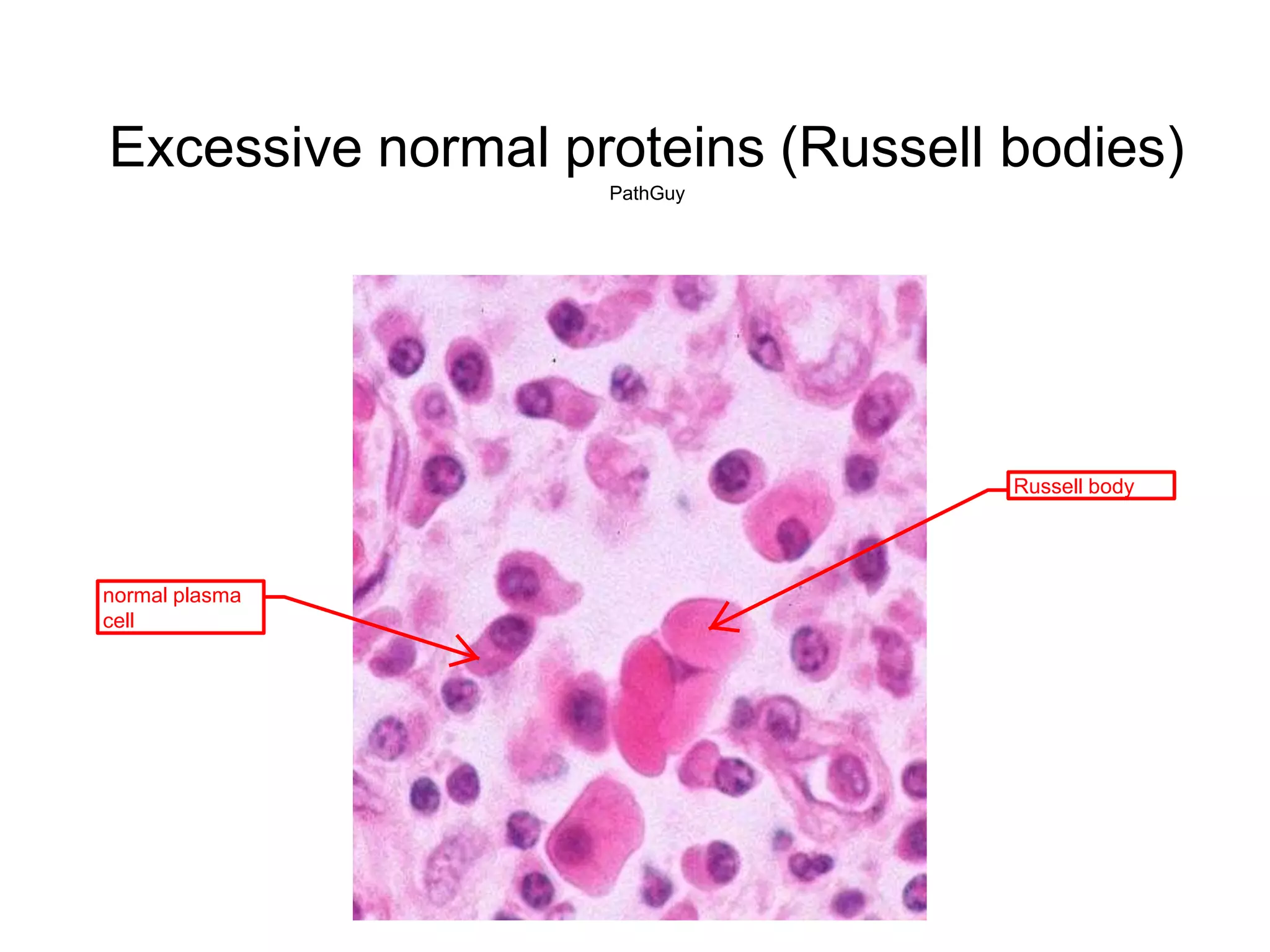 Excessive normal proteins (Russell bodies)
PathGuy
normal plasma
cell
Russell body
 