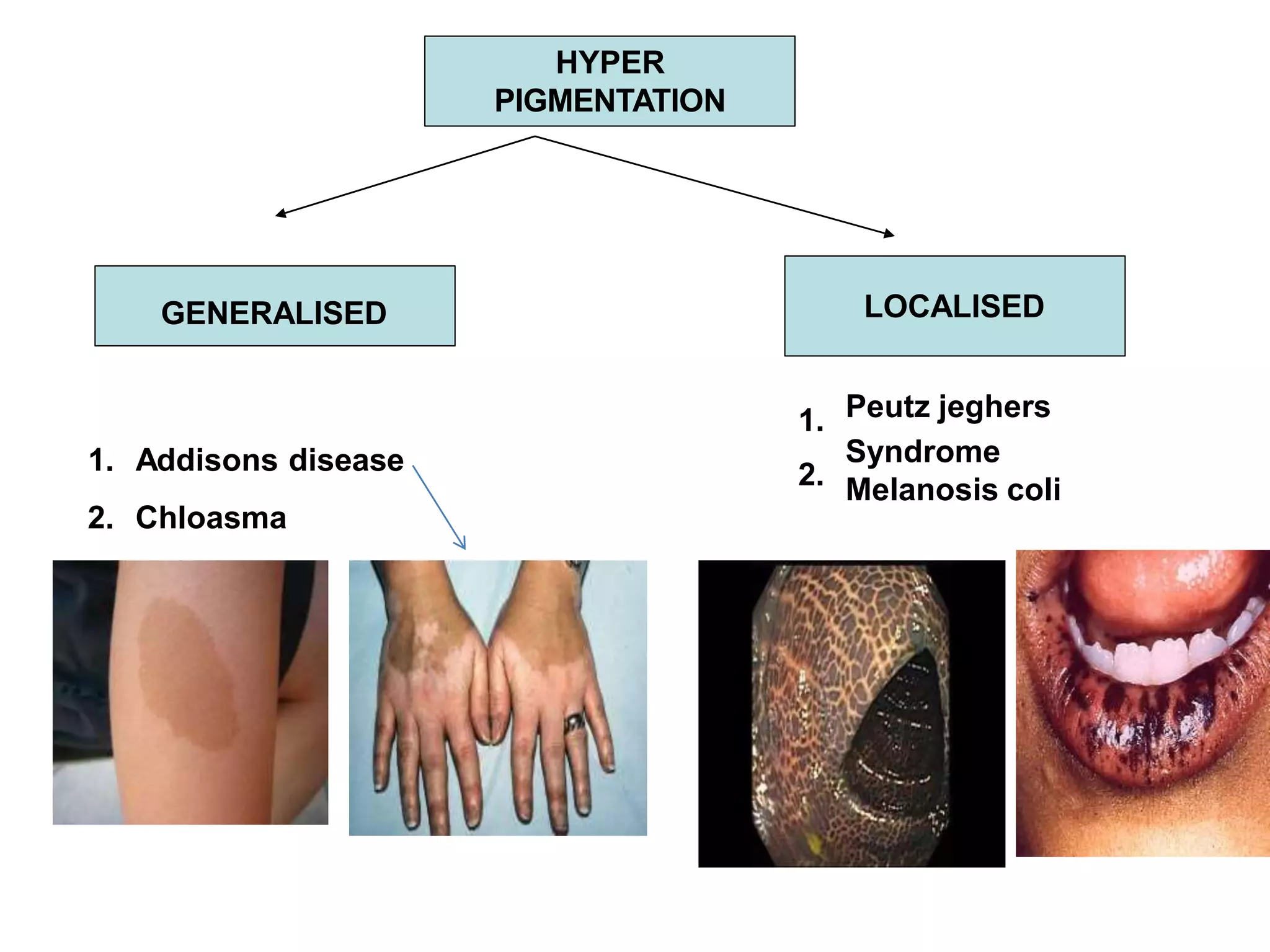 HYPER
PIGMENTATION
GENERALISED
1.
1. Addisons disease 2.
2. Chloasma
LOCALISED
Peutz jeghers
Syndrome
Melanosis coli
 