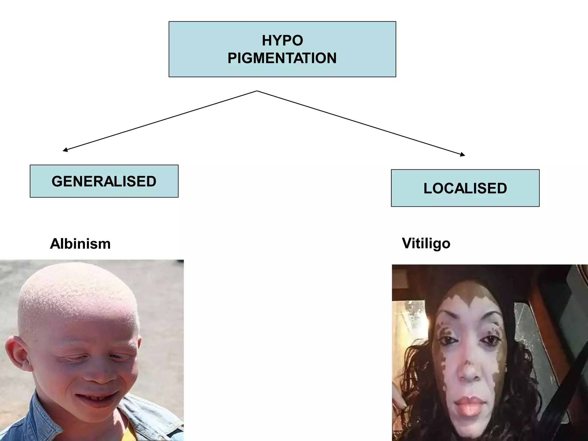 HYPO
PIGMENTATION
GENERALISED
Albinism
LOCALISED
Vitiligo
 