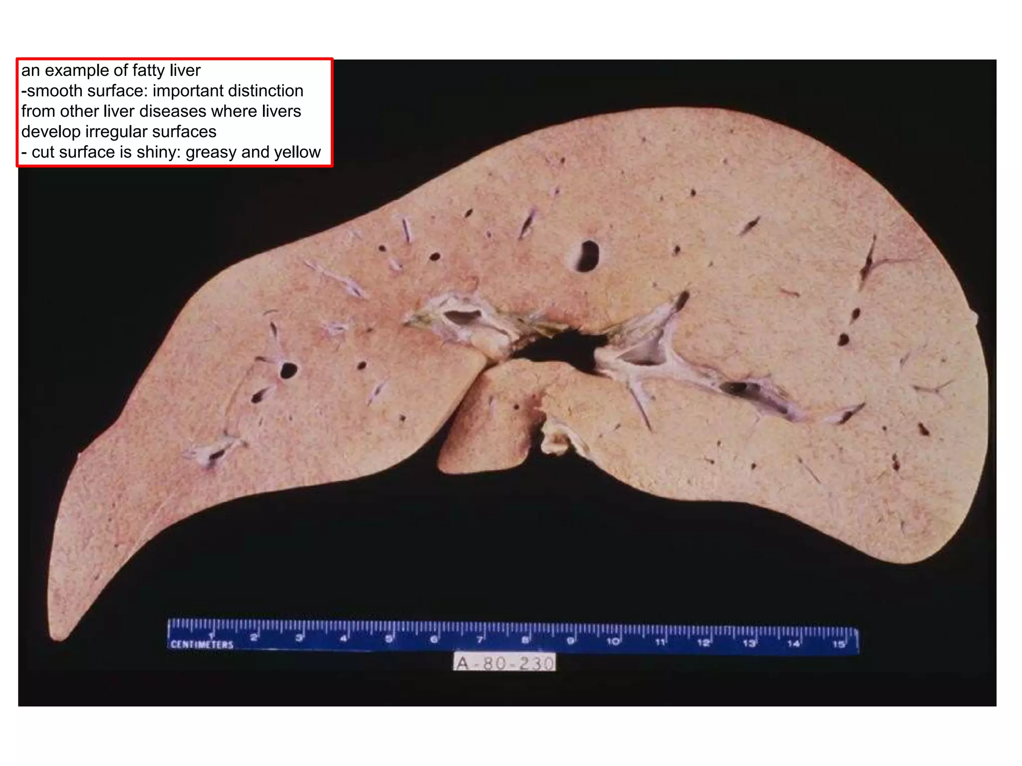 an example of fatty liver
-smooth surface: important distinction
from other liver diseases where livers
develop irregular surfaces
- cut surface is shiny: greasy and yellow
 