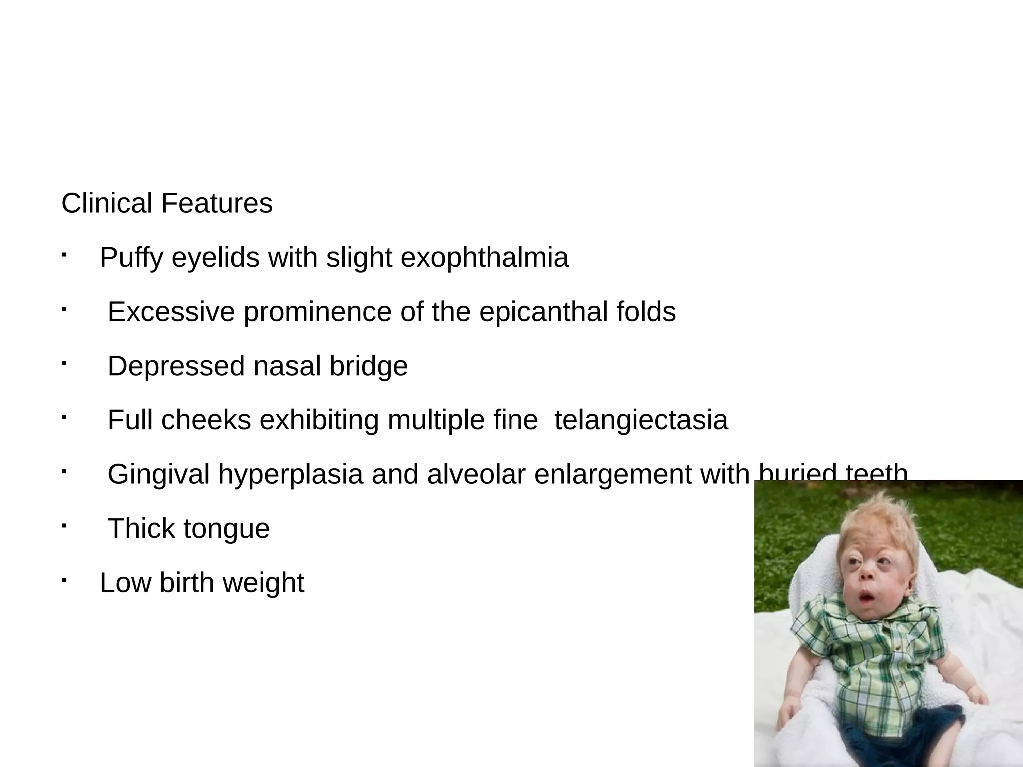 Clinical Features
§
Puffy eyelids with slight exophthalmia
§
Excessive prominence of the epicanthal folds
§
Depressed nasal bridge
§
Full cheeks exhibiting multiple fine telangiectasia
§
Gingival hyperplasia and alveolar enlargement with buried teeth
§
Thick tongue
§
Low birth weight
 