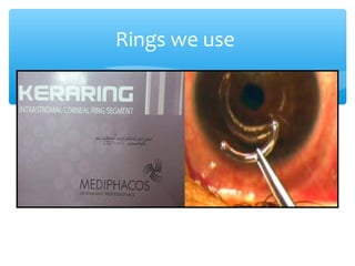 Rings we use
 