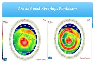Pre and post Kerarings Pentacam
 