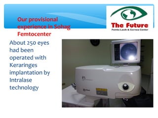 About 250 eyes
had been
operated with
Keraringes
implantation by
Intralase
technology
Our provisional
experience in Sohag
Femtocenter
 