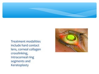 Treatment modalities
include hard contact
lens, corneal collagen
crosslinking,
Intracorneal ring
segments and
Keratoplasty
 