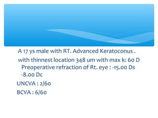 A 17 ys male with RT. Advanced Keratoconus .
with thinnest location 348 um with max k: 60 D
Preoperative refraction of Rt. eye : -15.00 Ds
-8.00 Dc
UNCVA : 2/60
BCVA : 6/60
 