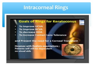 Intracorneal Rings
 