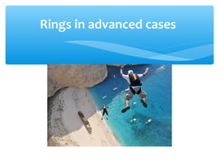 Rings in advanced cases
 