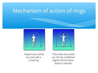 Mechanism of action of rings
 