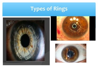 Types of Rings
 