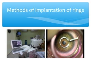 Methods of implantation of rings
 