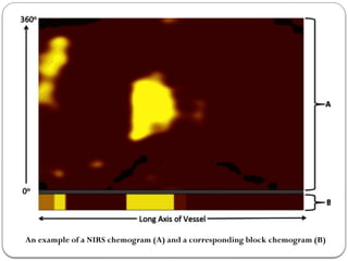 intracoronary imaging in cardiology .ppt