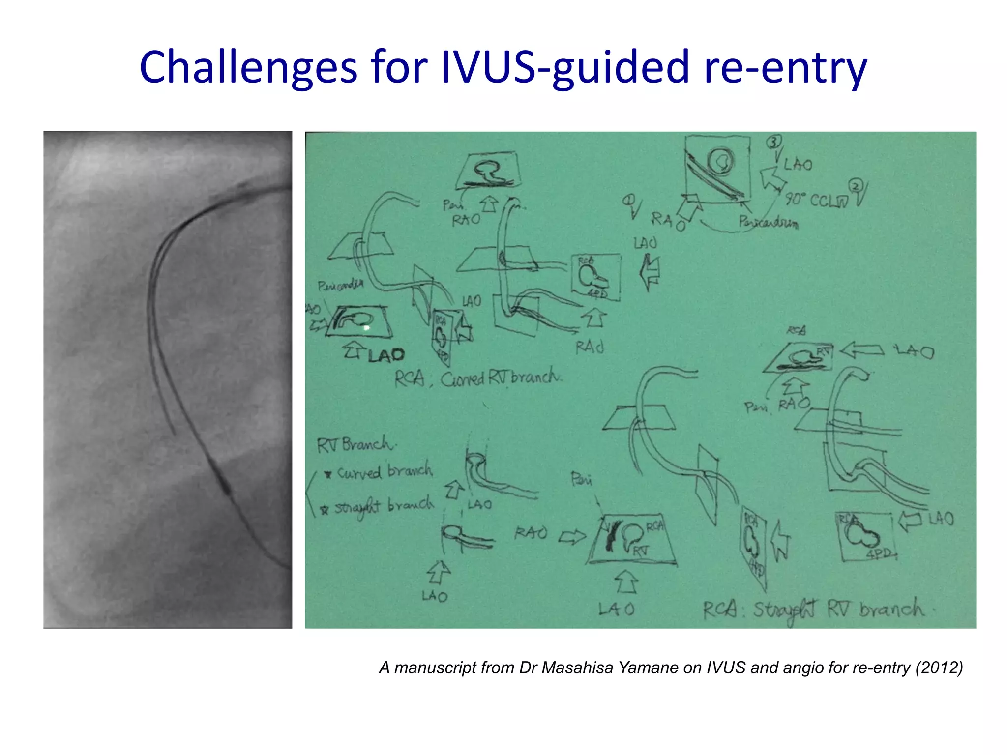 Intracoronary Imaging – when to use, how to use and how to interpret ...