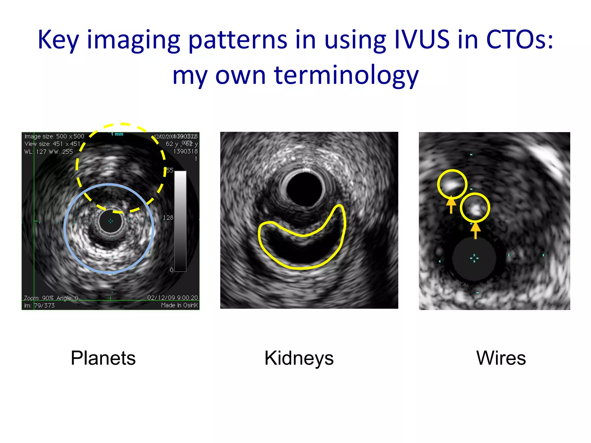 Intracoronary Imaging – when to use, how to use and how to interpret ...