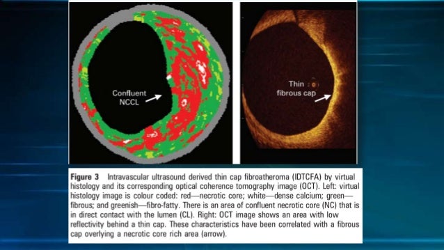 icd 10 pcs code for optical coherence tomography icd 10 pcs code for optical coherence tomography