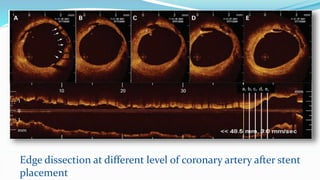 Edge Dissection Intracoronaryopticalcoherencetomography 130909083234- | PPTX
