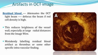 Oct Artefact Example Intracoronaryopticalcoherencetomography 130909083234- | PPTX