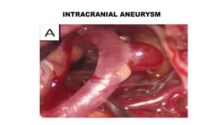INTRACRANIAL ANEURYSM
 