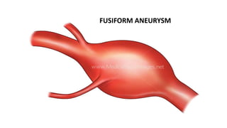 FUSIFORM ANEURYSM
 