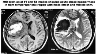 MRI brain axial T1 and T2 images showing acute phase haemorrhage
in right temporoparietal region with mass effect and midline shift.
 