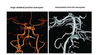 large vertebral junction aneurysm extravasation from the aneurysms
 