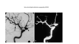 Intra arterial digital substration angiography (IADSA)
 