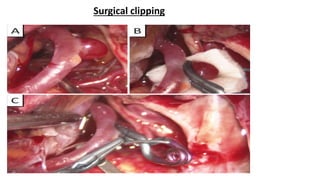 Surgical clipping
 
