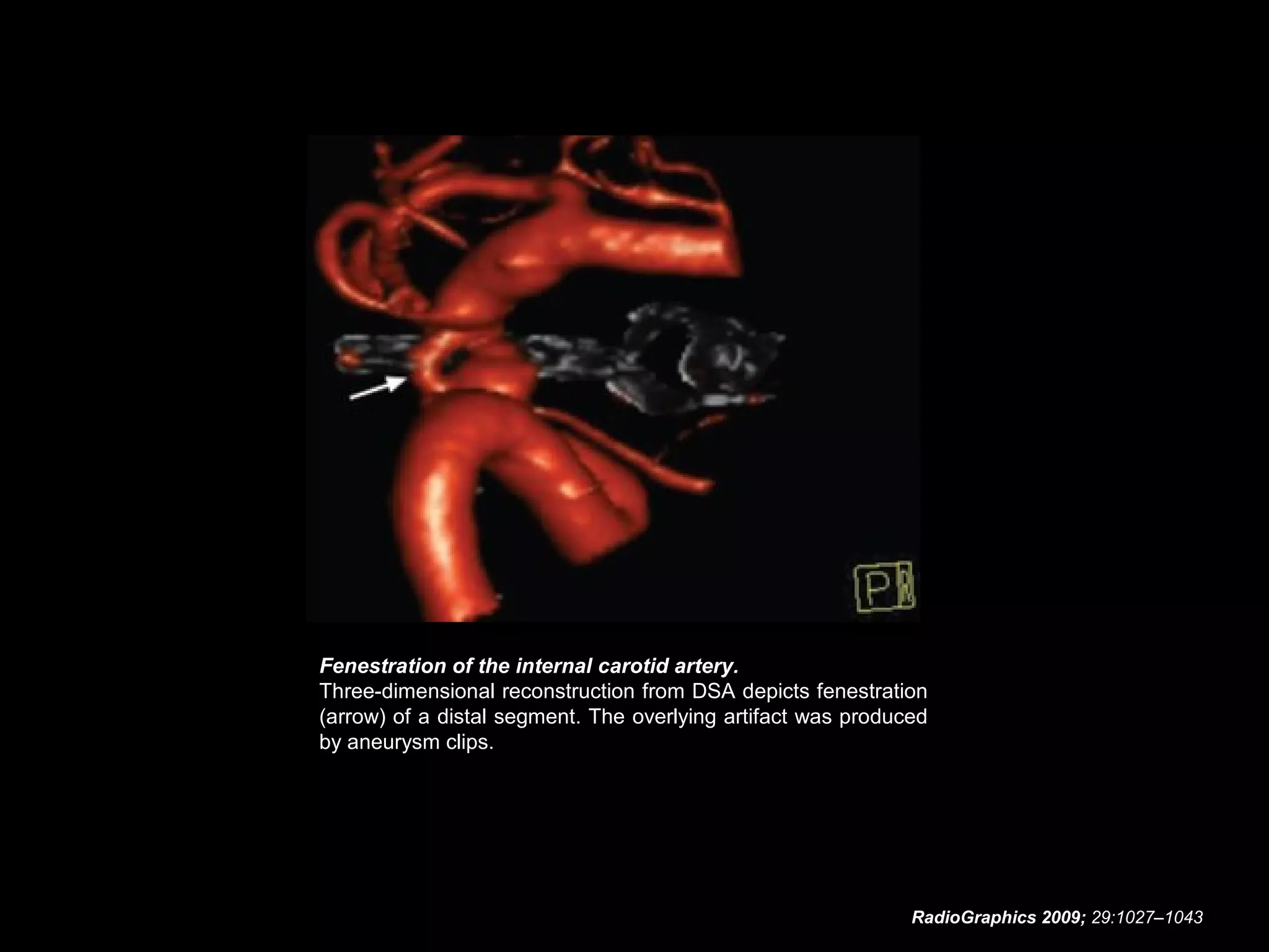 Fenestration of the internal carotid artery.
Three-dimensional reconstruction from DSA depicts fenestration
(arrow) of a distal segment. The overlying artifact was produced
by aneurysm clips.

RadioGraphics 2009; 29:1027–1043

 