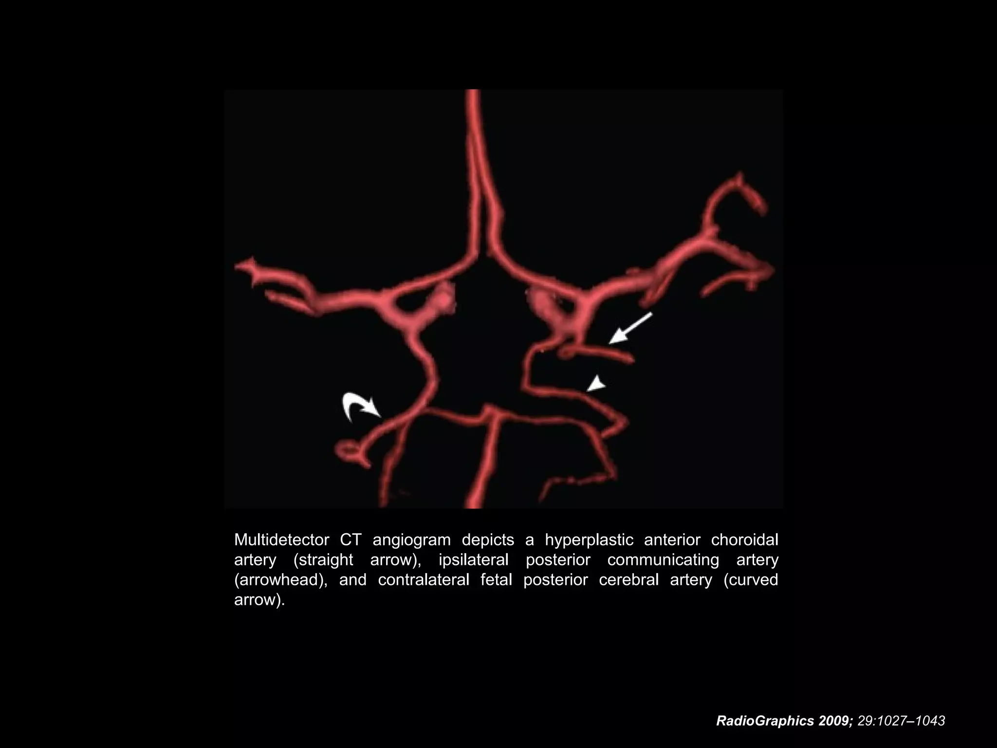 Multidetector CT angiogram depicts a hyperplastic anterior choroidal
artery (straight arrow), ipsilateral posterior communicating artery
(arrowhead), and contralateral fetal posterior cerebral artery (curved
arrow).

RadioGraphics 2009; 29:1027–1043

 