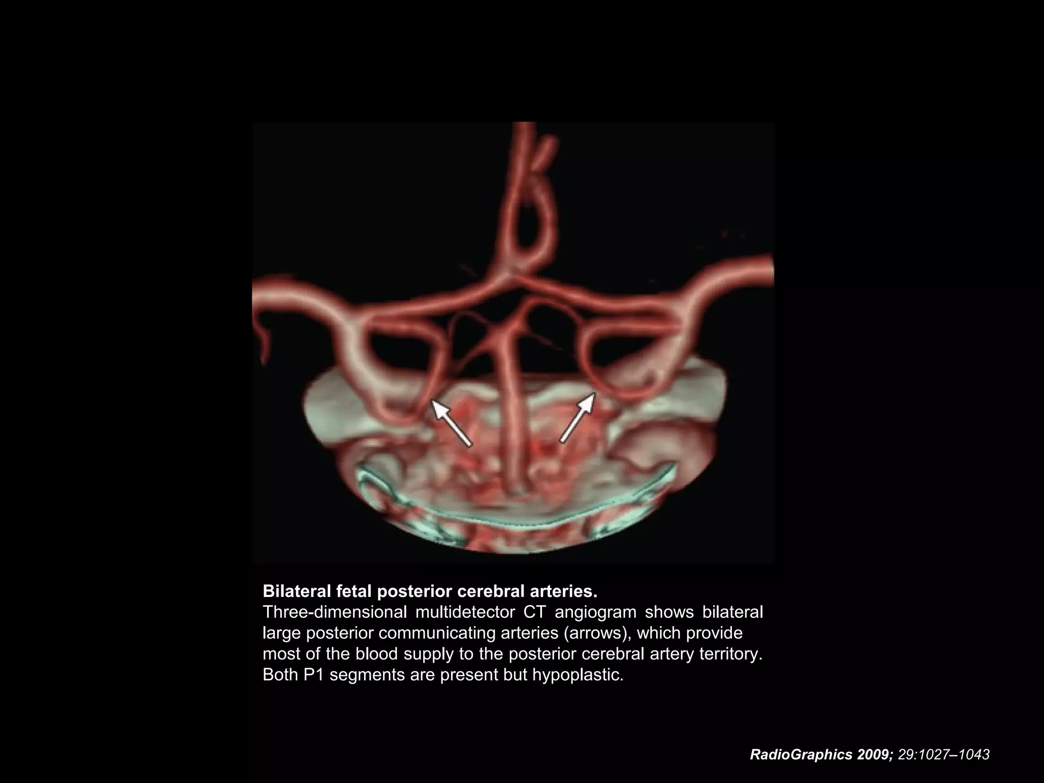 Bilateral fetal posterior cerebral arteries.
Three-dimensional multidetector CT angiogram shows bilateral
large posterior communicating arteries (arrows), which provide
most of the blood supply to the posterior cerebral artery territory.
Both P1 segments are present but hypoplastic.

RadioGraphics 2009; 29:1027–1043

 