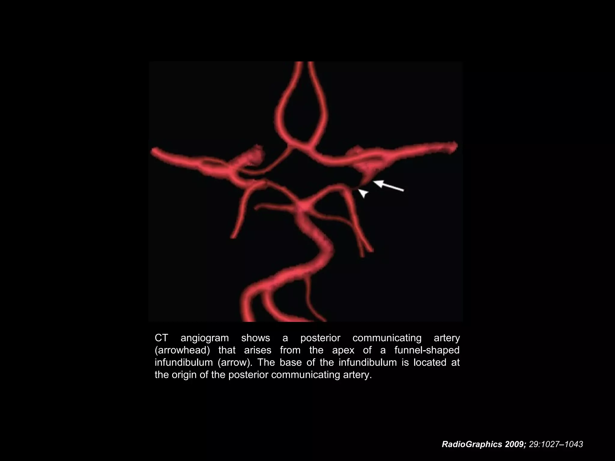 CT angiogram shows a posterior communicating artery
(arrowhead) that arises from the apex of a funnel-shaped
infundibulum (arrow). The base of the infundibulum is located at
the origin of the posterior communicating artery.

RadioGraphics 2009; 29:1027–1043

 