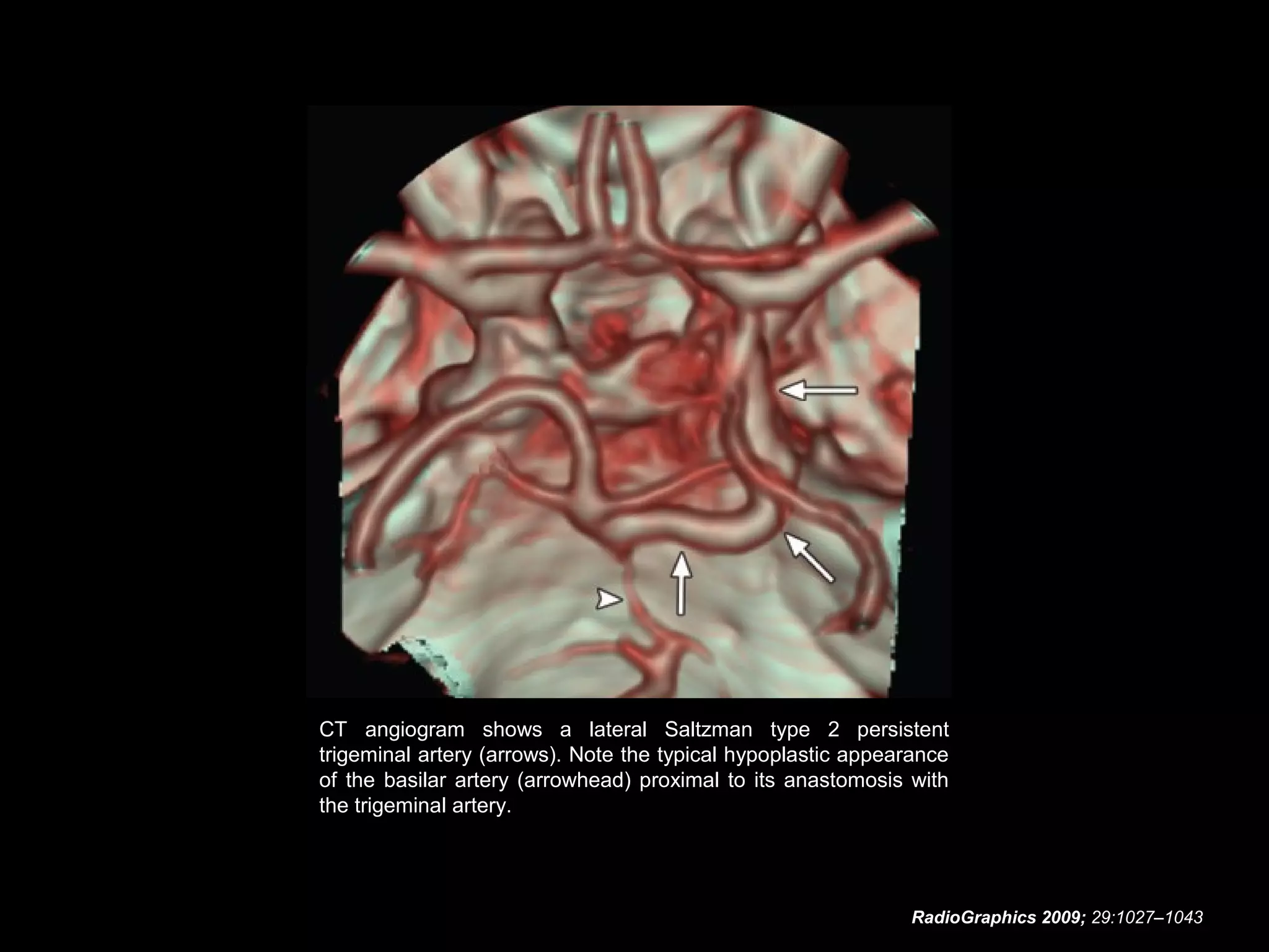 CT angiogram shows a lateral Saltzman type 2 persistent
trigeminal artery (arrows). Note the typical hypoplastic appearance
of the basilar artery (arrowhead) proximal to its anastomosis with
the trigeminal artery.

RadioGraphics 2009; 29:1027–1043

 