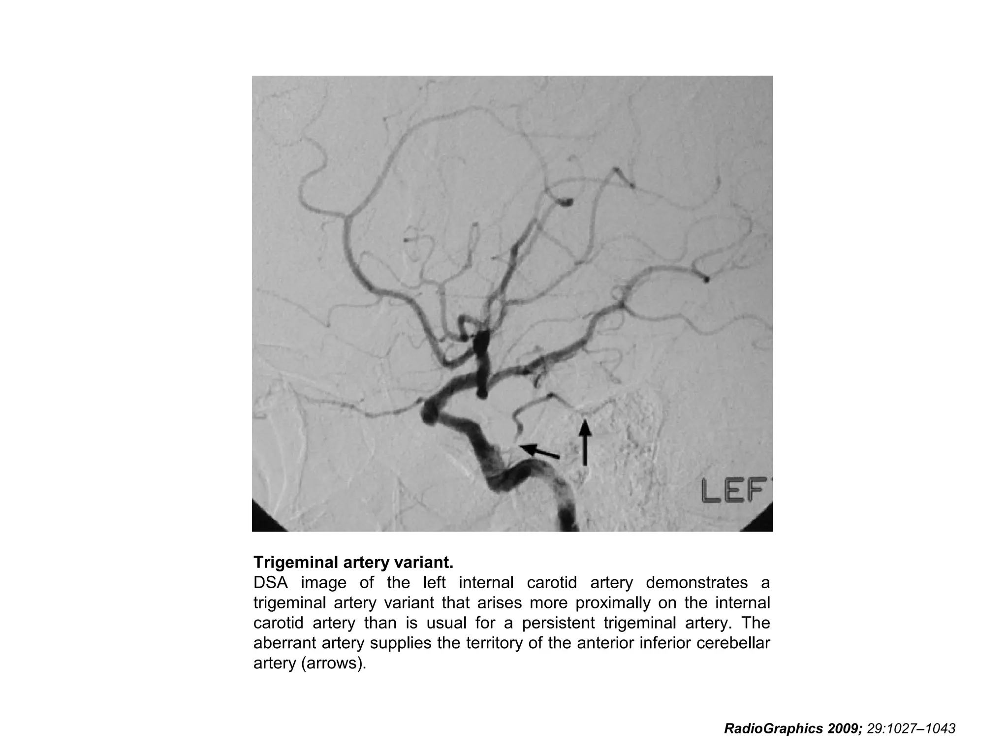 Trigeminal artery variant.
DSA image of the left internal carotid artery demonstrates a
trigeminal artery variant that arises more proximally on the internal
carotid artery than is usual for a persistent trigeminal artery. The
aberrant artery supplies the territory of the anterior inferior cerebellar
artery (arrows).

RadioGraphics 2009; 29:1027–1043

 