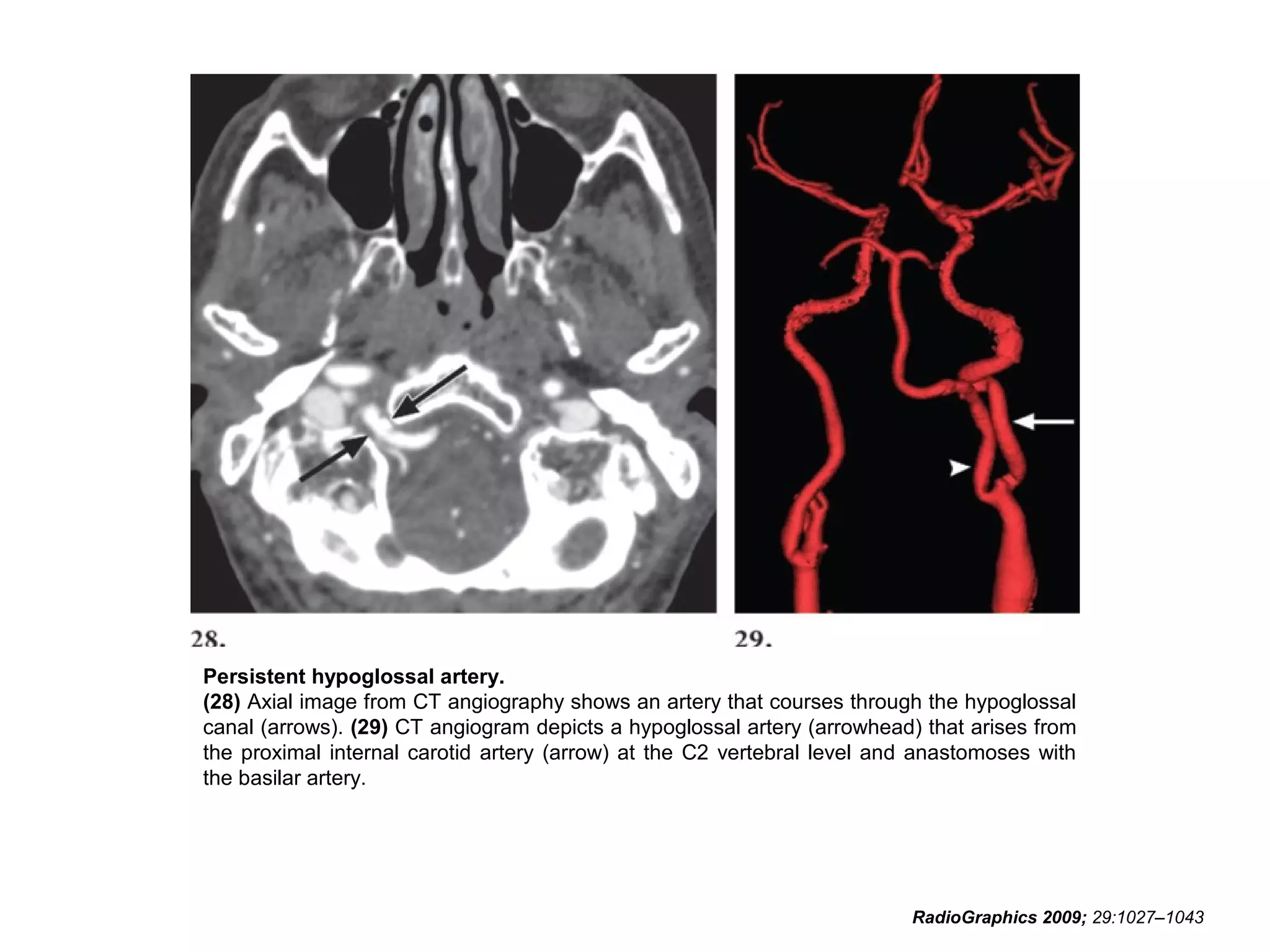 Persistent hypoglossal artery.
(28) Axial image from CT angiography shows an artery that courses through the hypoglossal
canal (arrows). (29) CT angiogram depicts a hypoglossal artery (arrowhead) that arises from
the proximal internal carotid artery (arrow) at the C2 vertebral level and anastomoses with
the basilar artery.

RadioGraphics 2009; 29:1027–1043

 
