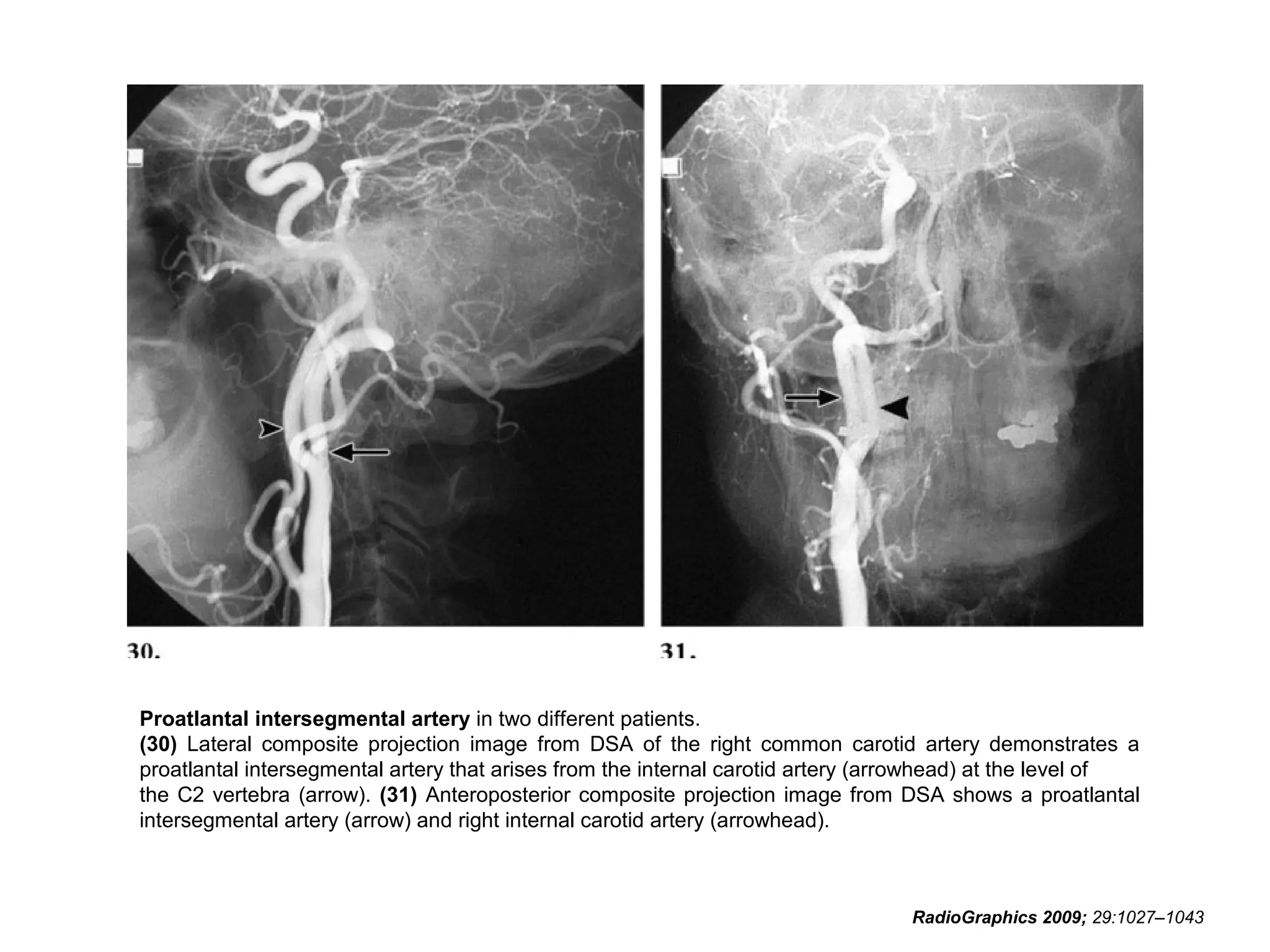 Proatlantal intersegmental artery in two different patients.
(30) Lateral composite projection image from DSA of the right common carotid artery demonstrates a
proatlantal intersegmental artery that arises from the internal carotid artery (arrowhead) at the level of
the C2 vertebra (arrow). (31) Anteroposterior composite projection image from DSA shows a proatlantal
intersegmental artery (arrow) and right internal carotid artery (arrowhead).

RadioGraphics 2009; 29:1027–1043

 