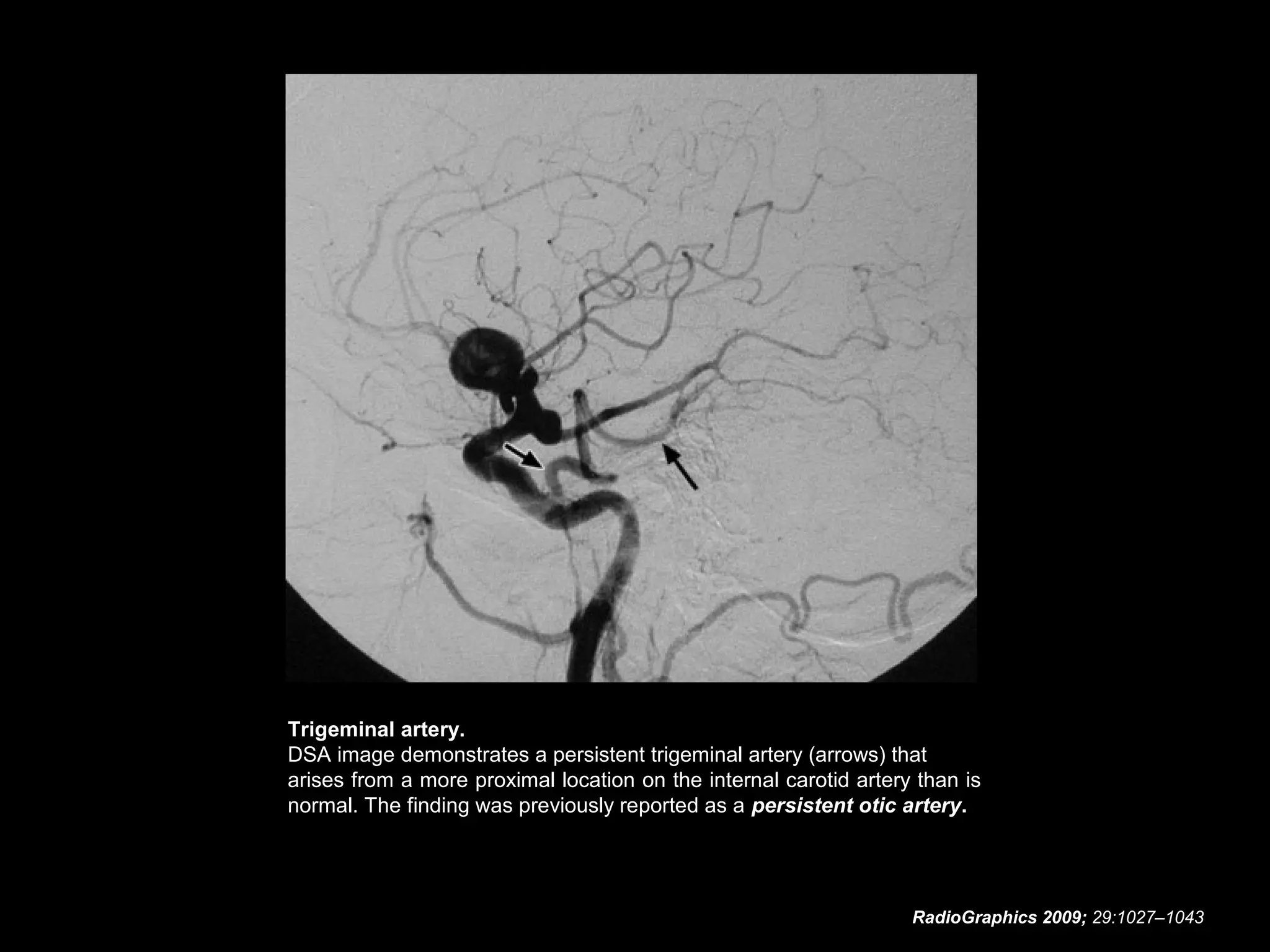 Trigeminal artery.
DSA image demonstrates a persistent trigeminal artery (arrows) that
arises from a more proximal location on the internal carotid artery than is
normal. The finding was previously reported as a persistent otic artery.

RadioGraphics 2009; 29:1027–1043

 