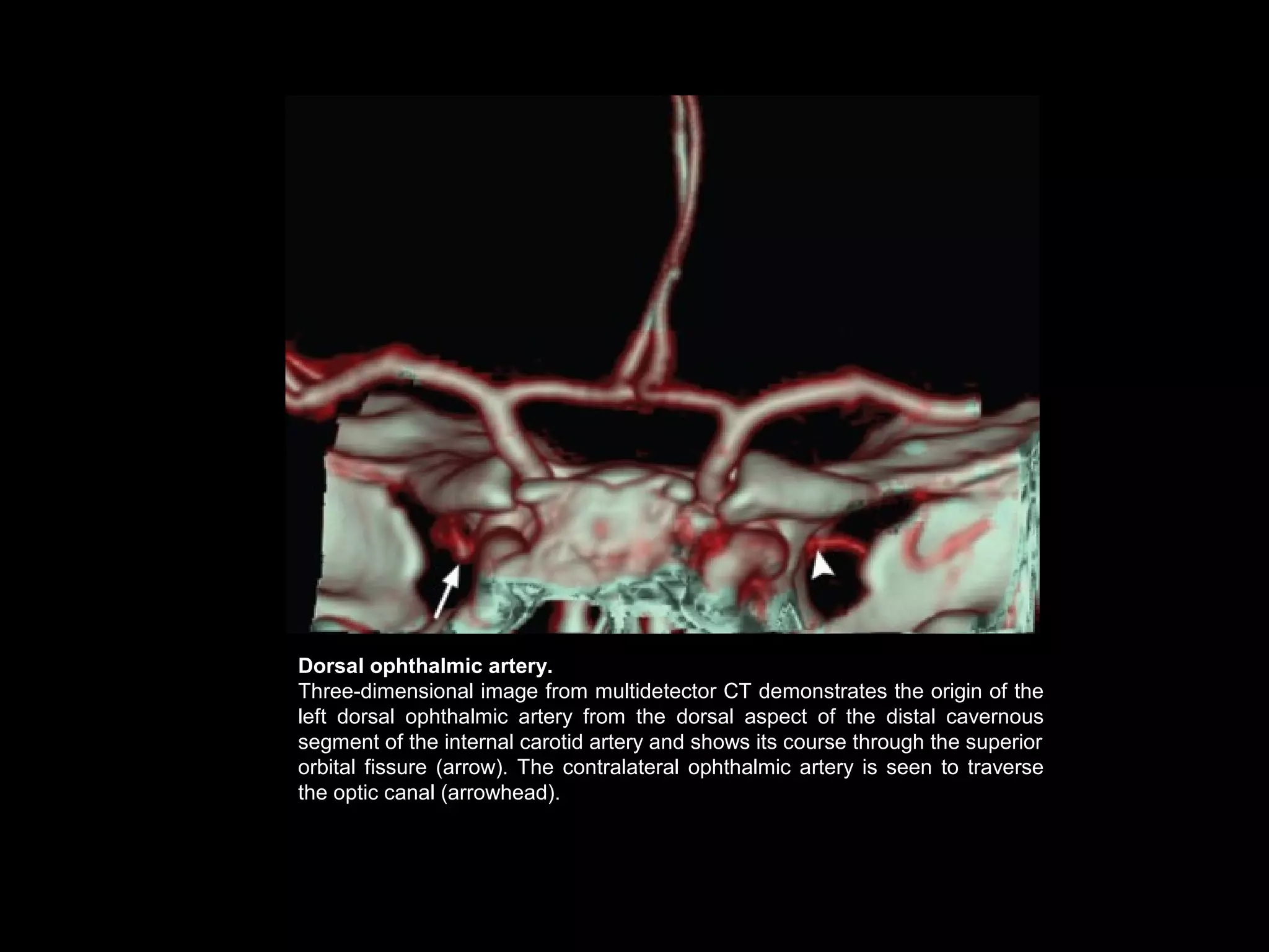 Dorsal ophthalmic artery.
Three-dimensional image from multidetector CT demonstrates the origin of the
left dorsal ophthalmic artery from the dorsal aspect of the distal cavernous
segment of the internal carotid artery and shows its course through the superior
orbital fissure (arrow). The contralateral ophthalmic artery is seen to traverse
the optic canal (arrowhead).

 