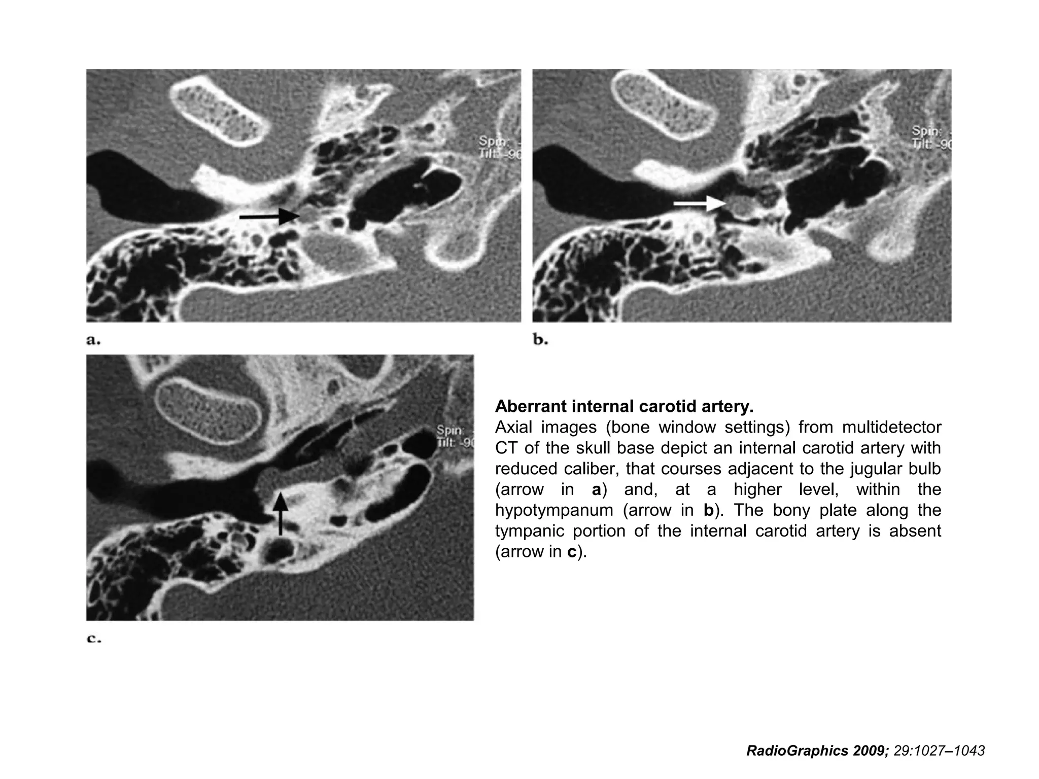 Aberrant internal carotid artery.
Axial images (bone window settings) from multidetector
CT of the skull base depict an internal carotid artery with
reduced caliber, that courses adjacent to the jugular bulb
(arrow in a) and, at a higher level, within the
hypotympanum (arrow in b). The bony plate along the
tympanic portion of the internal carotid artery is absent
(arrow in c).

RadioGraphics 2009; 29:1027–1043

 