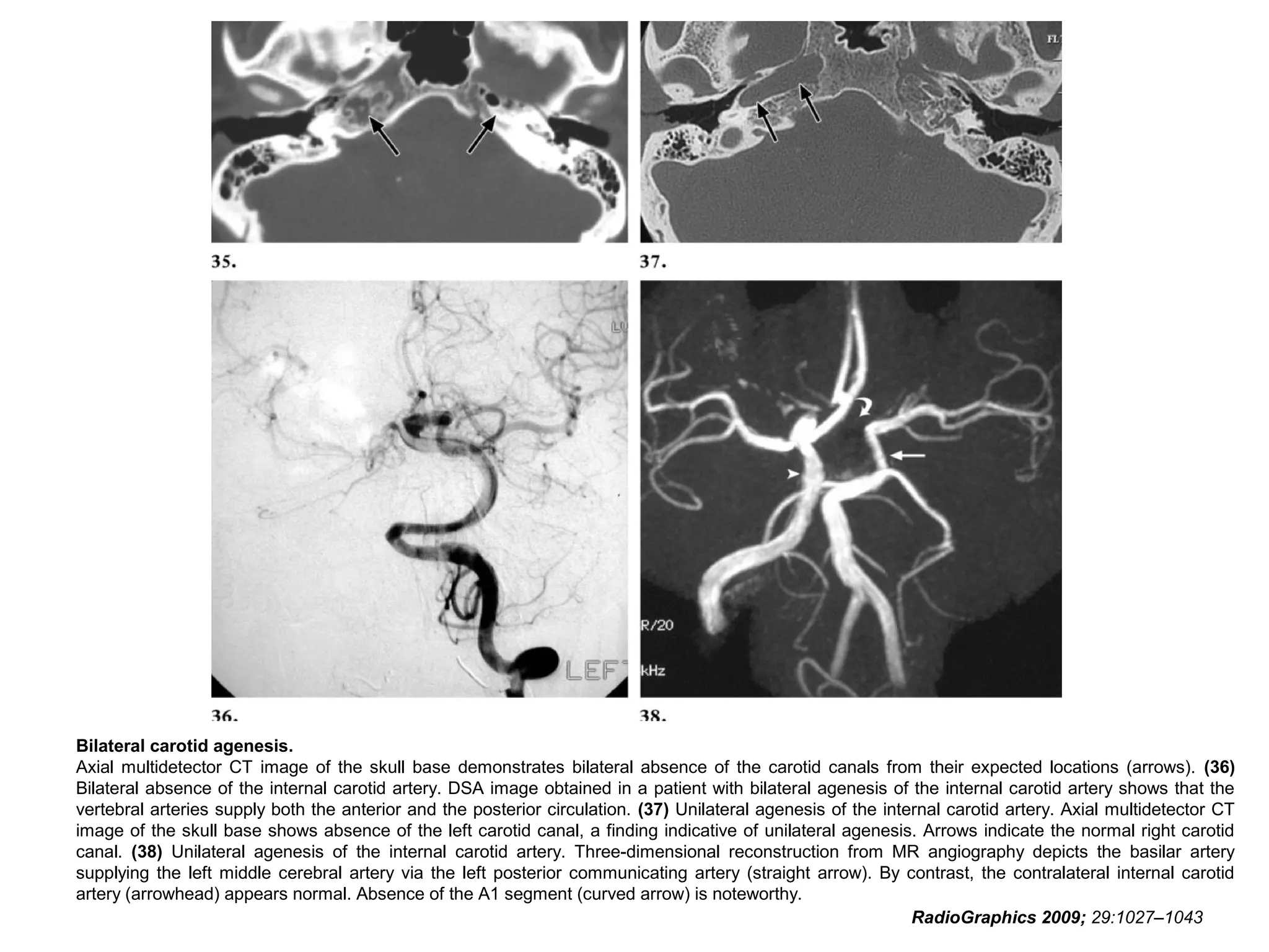 Bilateral carotid agenesis.
Axial multidetector CT image of the skull base demonstrates bilateral absence of the carotid canals from their expected locations (arrows). (36)
Bilateral absence of the internal carotid artery. DSA image obtained in a patient with bilateral agenesis of the internal carotid artery shows that the
vertebral arteries supply both the anterior and the posterior circulation. (37) Unilateral agenesis of the internal carotid artery. Axial multidetector CT
image of the skull base shows absence of the left carotid canal, a finding indicative of unilateral agenesis. Arrows indicate the normal right carotid
canal. (38) Unilateral agenesis of the internal carotid artery. Three-dimensional reconstruction from MR angiography depicts the basilar artery
supplying the left middle cerebral artery via the left posterior communicating artery (straight arrow). By contrast, the contralateral internal carotid
artery (arrowhead) appears normal. Absence of the A1 segment (curved arrow) is noteworthy.
RadioGraphics 2009; 29:1027–1043

 