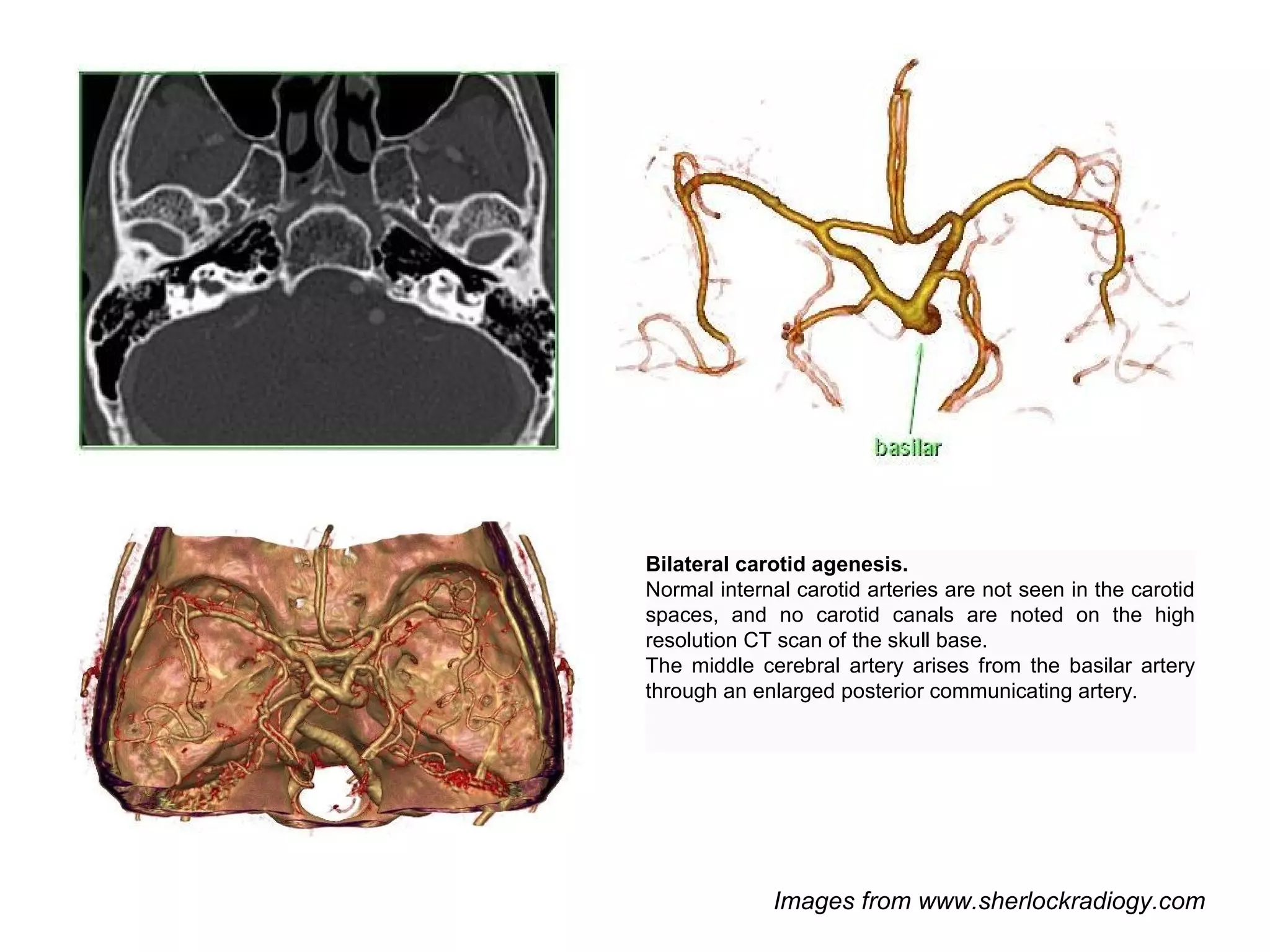Bilateral carotid agenesis.
Normal internal carotid arteries are not seen in the carotid
spaces, and no carotid canals are noted on the high
resolution CT scan of the skull base.
The middle cerebral artery arises from the basilar artery
through an enlarged posterior communicating artery.

Images from www.sherlockradiogy.com

 