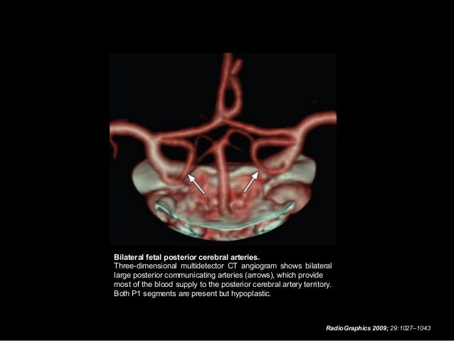 Internal Carotid Artery and Normal Variants