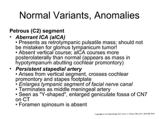 Normal Variants, Anomalies
Petrous (C2) segment
• Aberrant ICA (aICA)
• Presents as retrotympanic pulsatile mass; should not
be mistaken for glomus tympanicum tumor!
• Absent vertical course; alCA courses more
posterolaterally than normal (appears as mass in
hypotympanum abutting cochlear promontory)
• Persistent stapedial artery
• Arises from vertical segment, crosses cochlear
promontory and stapes footplate
• Enlarges tympanic segment of facial nerve canal
• Terminates as middle meningeal artery
• Seen as "Y-shaped", enlarged geniculate fossa of CN7
on CT
• Foramen spinosum is absent

 