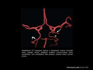 Multidetector CT angiogram depicts a hyperplastic anterior choroidal
artery (straight arrow), ipsilateral posterior communicating artery
(arrowhead), and contralateral fetal posterior cerebral artery (curved
arrow).

RadioGraphics 2009; 29:1027–1043

 
