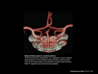 Bilateral fetal posterior cerebral arteries.
Three-dimensional multidetector CT angiogram shows bilateral
large posterior communicating arteries (arrows), which provide
most of the blood supply to the posterior cerebral artery territory.
Both P1 segments are present but hypoplastic.

RadioGraphics 2009; 29:1027–1043

 