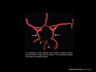 CT angiogram shows bilateral fetal posterior cerebral arteries
(arrows). Both P1 segments are absent. The arrowheads indicate
the superior cerebellar arteries.

RadioGraphics 2009; 29:1027–1043

 