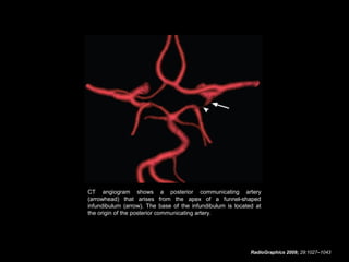 CT angiogram shows a posterior communicating artery
(arrowhead) that arises from the apex of a funnel-shaped
infundibulum (arrow). The base of the infundibulum is located at
the origin of the posterior communicating artery.

RadioGraphics 2009; 29:1027–1043

 