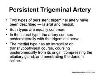 Persistent Trigeminal Artery
• Two types of persistent trigeminal artery have
been described — lateral and medial.
• Both types are equally common.
• In the lateral type, the artery courses
posterolaterally with the trigeminal nerve.
• The medial type has an intrasellar or
transhypophyseal course, coursing
posteromedially from its origin, compressing the
pituitary gland, and penetrating the dorsum
sellae.
RadioGraphics 2009; 29:1027–1043

 